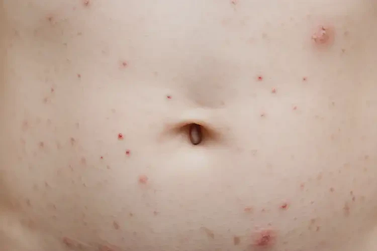 少兒肚子上偶爾起濕疹不管它會自己好嗎(圖4)