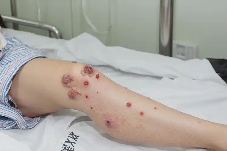 產(chǎn)婦小腿長濕疹可不可以根治(圖3)