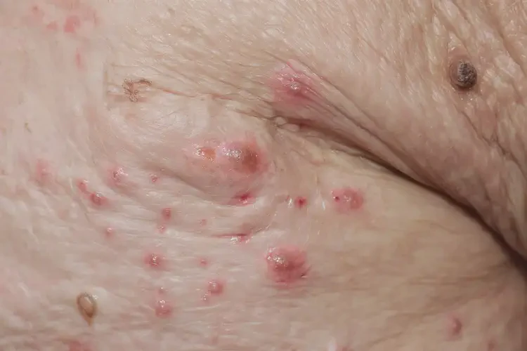 老人屁股容易長(zhǎng)濕疹可不可以根治(圖4)