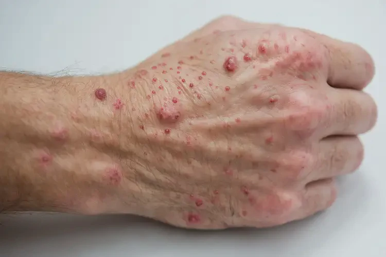 男性手上偶爾長濕疹可不可以根治(圖2)