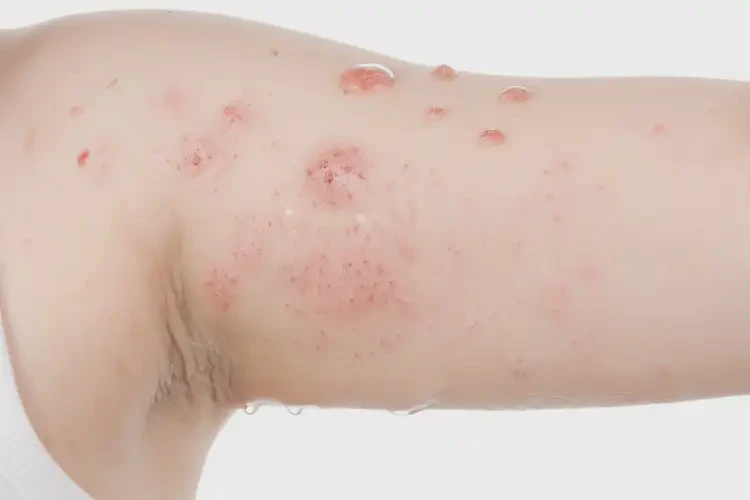 小學(xué)生手臂上經(jīng)常起濕疹能夠徹底治愈嗎(圖4)