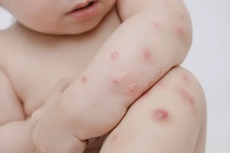 幼儿屁股上有湿疹可不可以根治(图4)