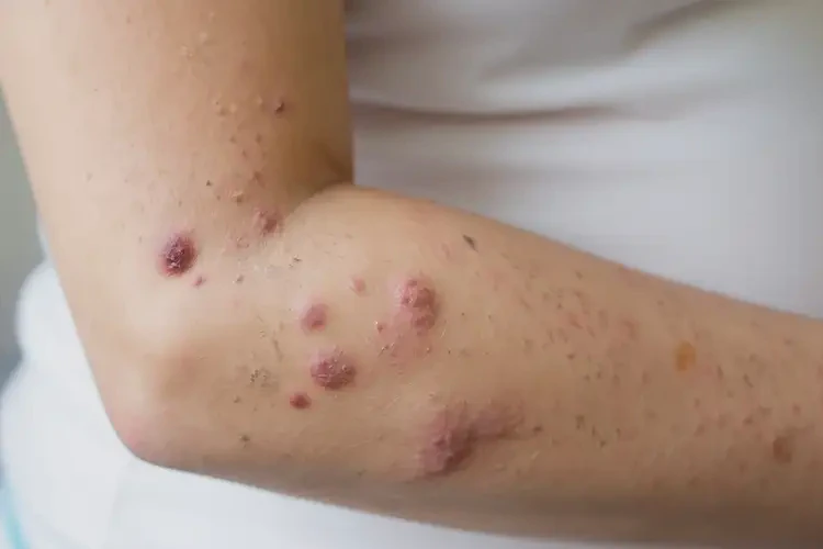 產(chǎn)婦手臂上偶爾長(zhǎng)濕疹可不可以根治(圖4)