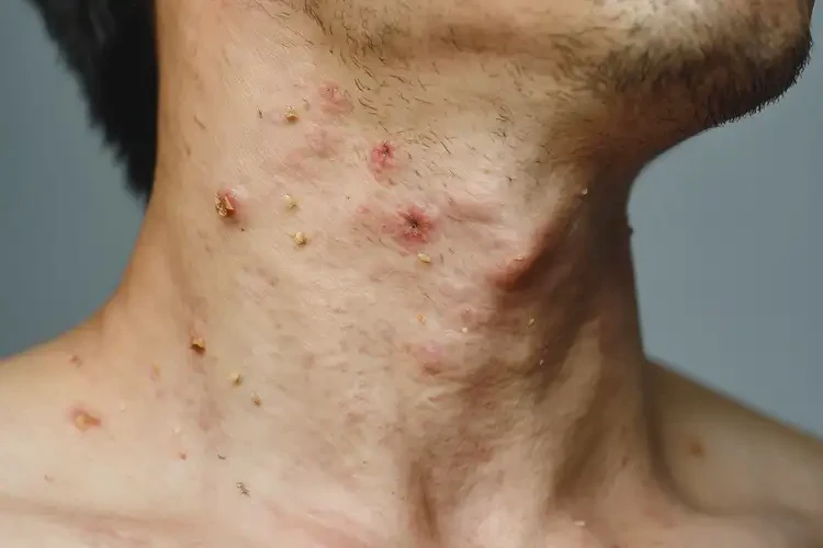 男性脖子長濕疹可不可以根治(圖4)