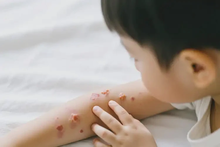 小孩手臂上偶爾起濕疹可不可以根治(圖3)