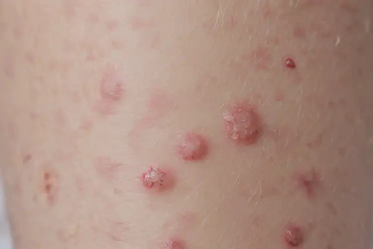 兒童小腿上長(zhǎng)濕疹可不可以根治(圖4)