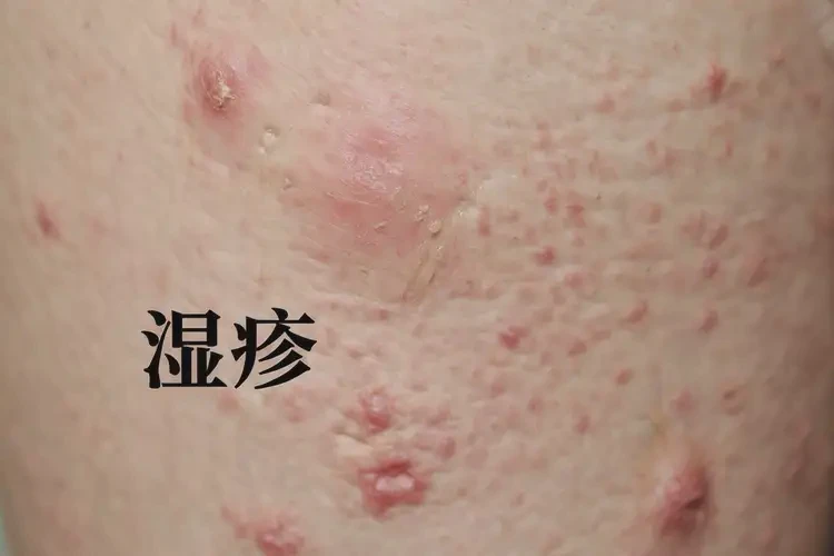 女生大腿经常长湿疹不管它会自己痊愈吗(图4)