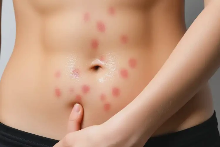 女人肚子上有湿疹可不可以根治(图1)