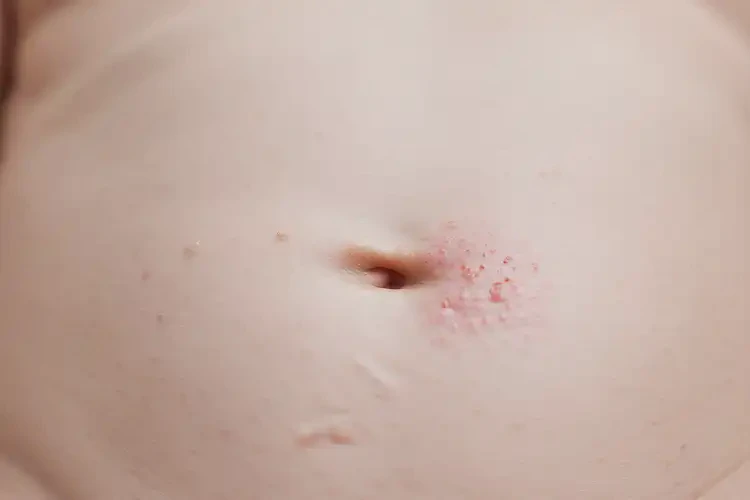 新生兒肚子上偶爾長濕疹可以治好嗎(圖4)