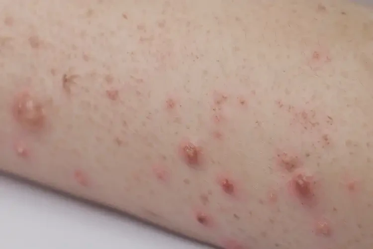 少兒手上起濕疹可以治好嗎(圖4)