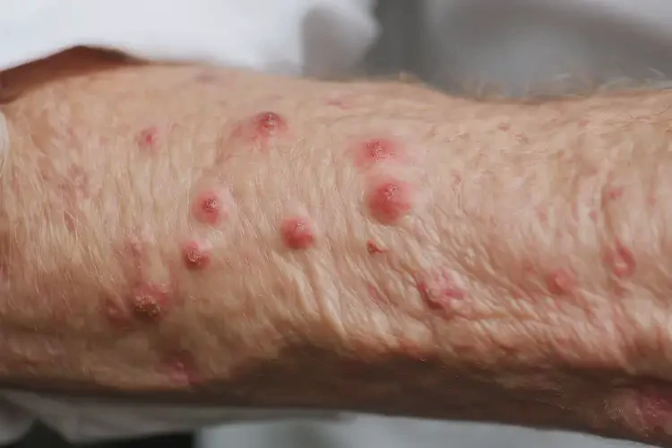 老人手臂上出濕疹可以治好嗎(圖4)