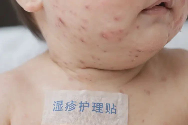 寶寶脖子上出濕疹可以治好嗎(圖4)