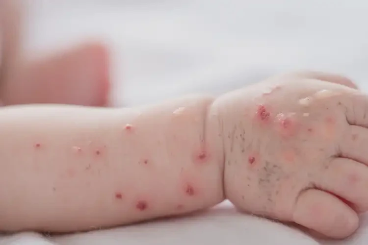 新生兒手臂容易起濕疹可不可以根治(圖4)