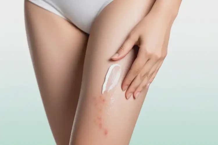 女生大腿偶爾長(zhǎng)濕疹可不可以根治(圖4)