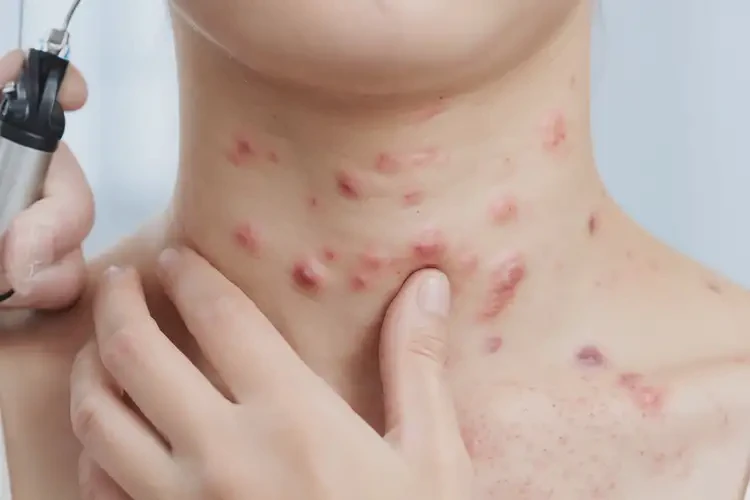 女生脖子上出現(xiàn)濕疹可以治好嗎(圖4)