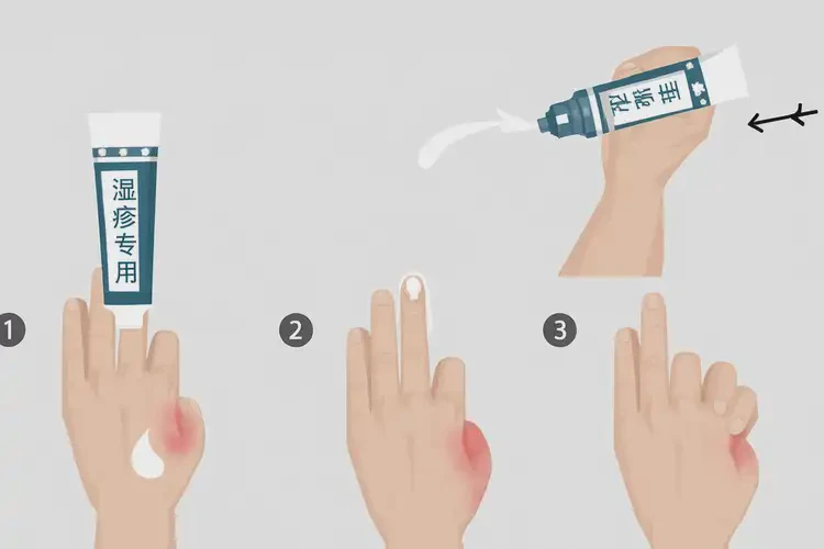 男性屁股上有濕疹可以治好嗎(圖3)