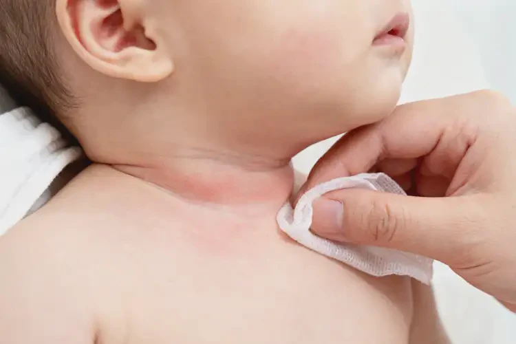 嬰幼兒脖子偶爾長(zhǎng)濕疹可以治好嗎(圖1)