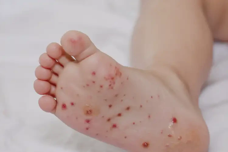 幼兒腳上有濕疹可以治好嗎(圖4)