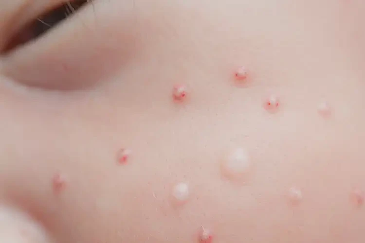 新生兒身上偶爾長濕疹可以治好嗎(圖3)