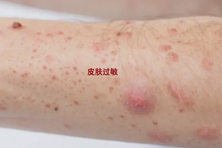 男性手臂容易起濕疹可以治好嗎(圖4)