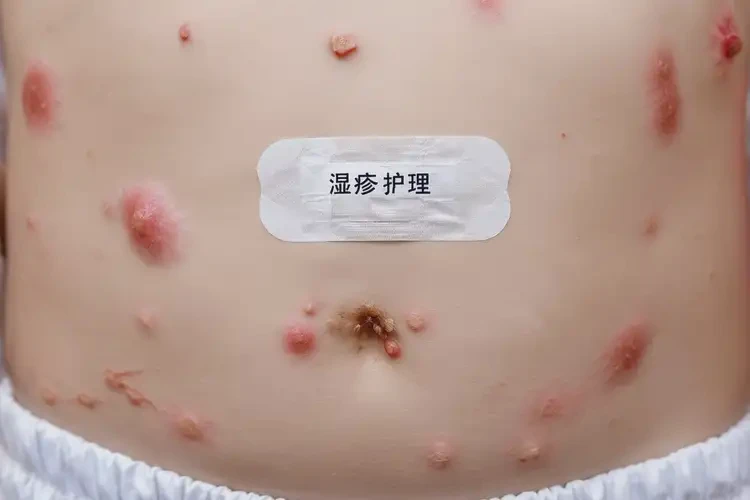 小學(xué)生肚子起濕疹可不可以根治(圖4)