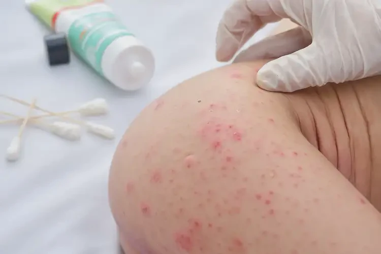 新生兒屁股上出現(xiàn)濕疹能靠自己自愈嗎(圖4)