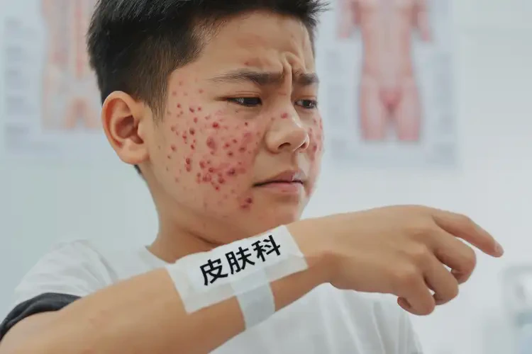 男生四肢經(jīng)常起濕疹可以治好嗎(圖4)