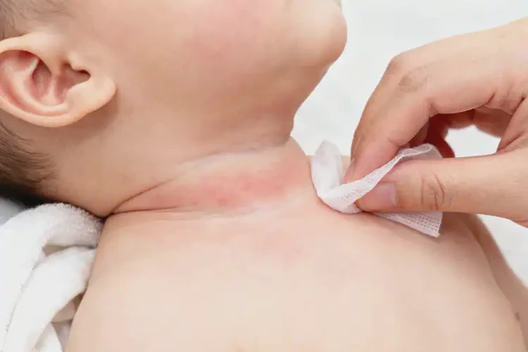 嬰幼兒脖子偶爾長(zhǎng)濕疹可以治好嗎(圖3)