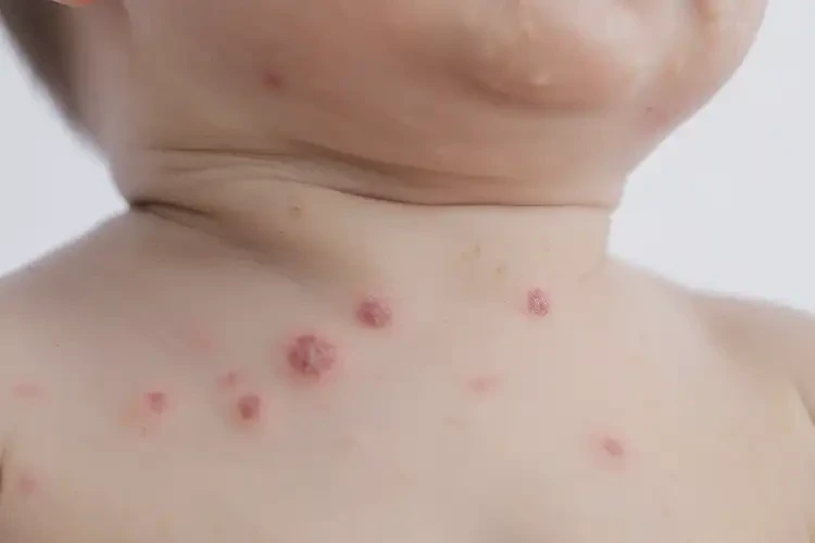小兒脖子上出濕疹可以治好嗎(圖4)