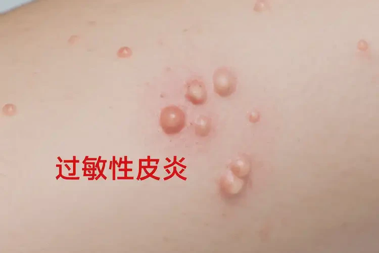 男性大腿經(jīng)常長(zhǎng)濕疹能夠徹底治愈嗎(圖4)