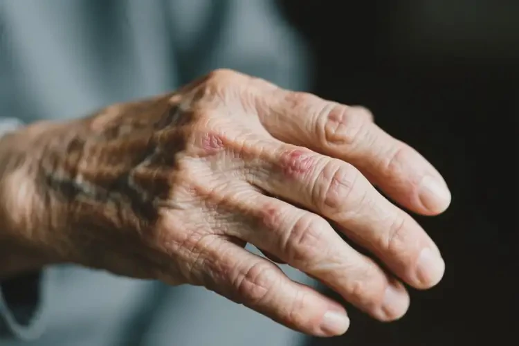 老年人身上经常长湿疹可不可以根治(图1)