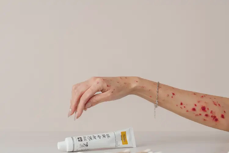 女性手上有濕疹不管它會(huì)自己痊愈嗎(圖3)
