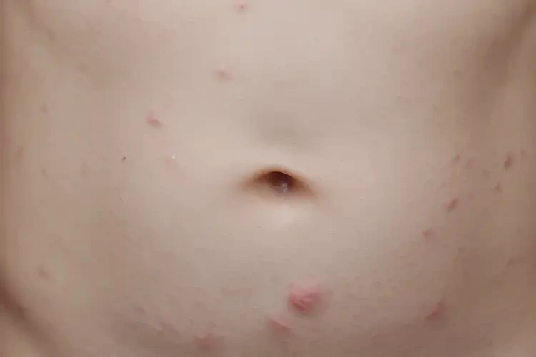 兒童肚子偶爾起濕疹可以徹底自愈嗎(圖3)