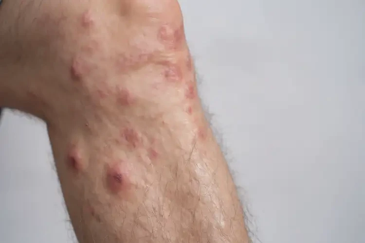 老人小腿经常起湿疹可以治好吗(图4)