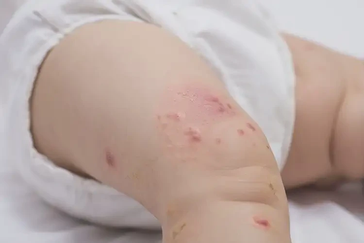 嬰兒大腿上經(jīng)常起濕疹可以治好嗎(圖4)