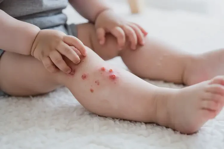 幼兒大腿上容易起濕疹可不可以根治(圖4)