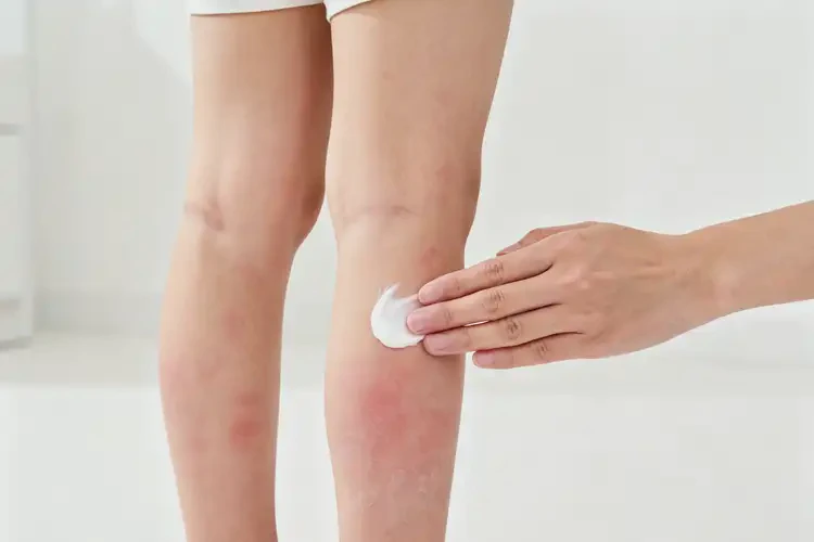 小孩小腿上經(jīng)常長濕疹可以治好嗎(圖3)