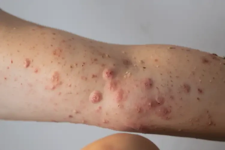 女生四肢經(jīng)常長濕疹可以治好嗎(圖4)