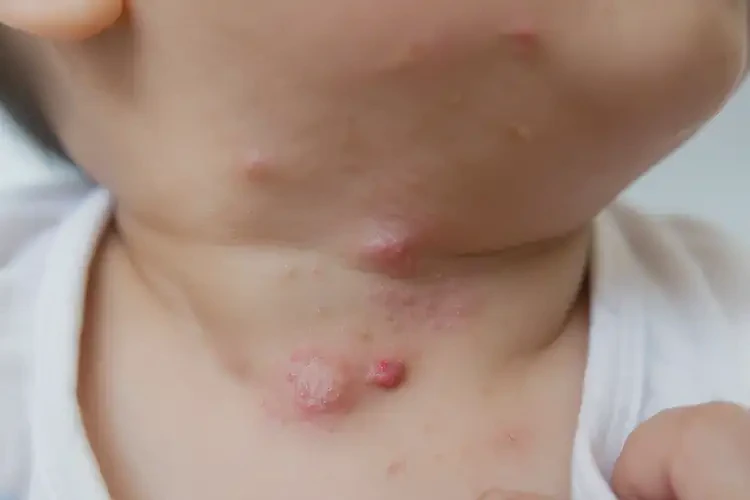 幼儿脖子出现湿疹可以治好吗(图4)