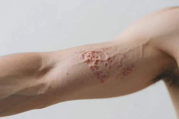 男人手臂容易長(zhǎng)濕疹可不可以根治(圖3)