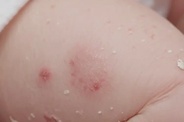 新生兒大腿上經(jīng)常起濕疹可不可以根治(圖4)