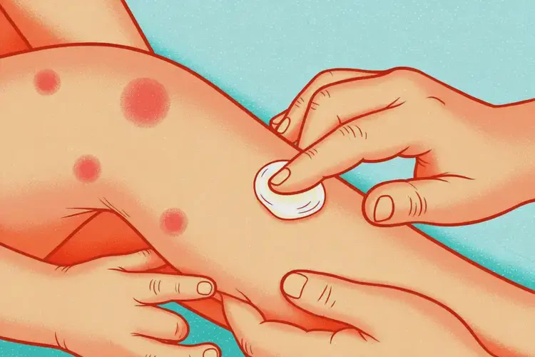 小兒四肢出濕疹可不可以根治(圖4)