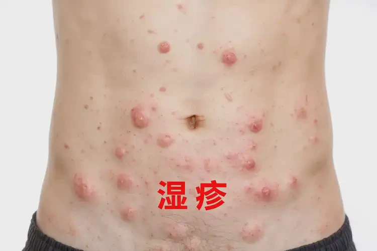 青年人肚子上偶爾長(zhǎng)濕疹可以治好嗎(圖4)