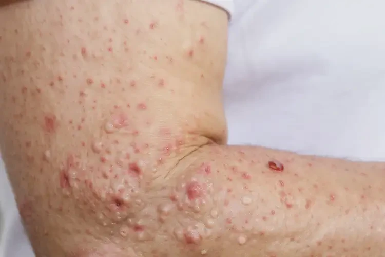 女性手臂出現(xiàn)濕疹可以治好嗎(圖4)