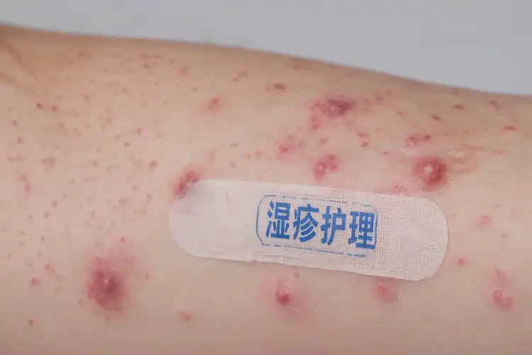 少兒手臂出現(xiàn)濕疹可以治好嗎(圖4)