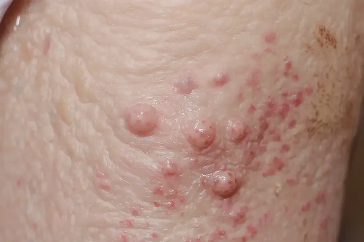 老年人肛周經(jīng)常長濕疹可以治好嗎(圖4)