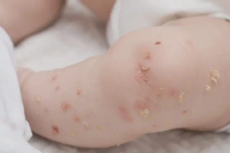 小孩小腿上起濕疹不管它會自己好嗎(圖4)