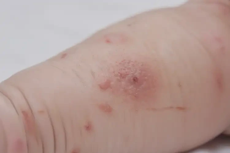 寶寶小腿上容易起濕疹可以治好嗎(圖4)