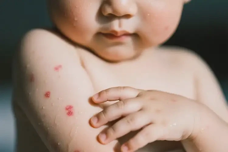 小孩手臂上偶爾起濕疹可以治好嗎(圖1)