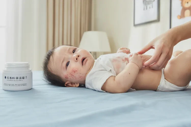 寶寶肚子容易長濕疹可以治愈嗎(圖1)
